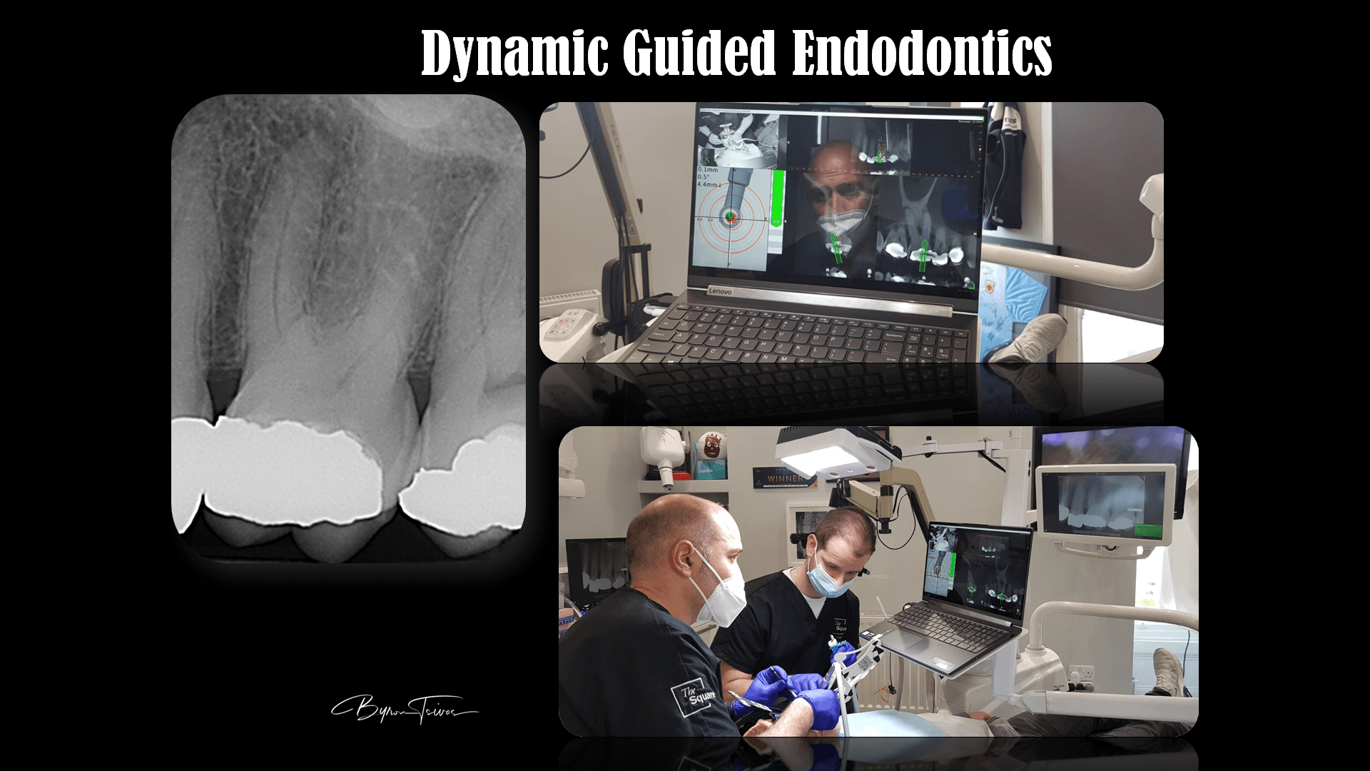 Guided endodontics - Case 1